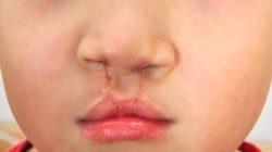 Operasi Celah Bibir dan Lelangit Gratis Untuk Bayi di Makassar, Cek Syaratnya